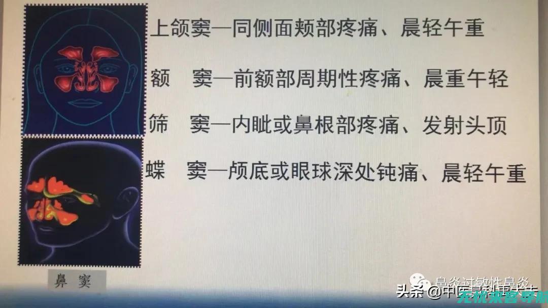 鼻窦炎不用怕冷吗