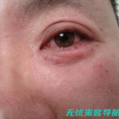 眼睛痒得难受？专家指导如何缓解过敏性鼻炎症状 (眼睛痒得难受,滴眼药都不管用)