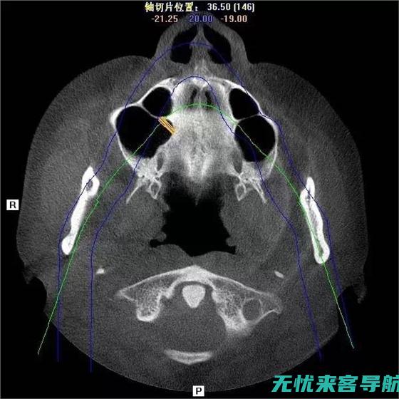 上颌窦炎全解析：症状、诊断与治疗方法 (上颌窦炎病程)