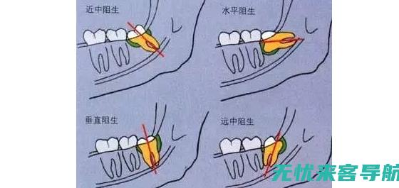 面对智齿肿痛