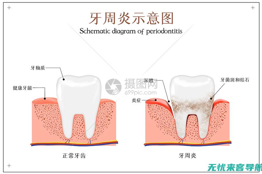 智齿牙龈可以拔牙吗