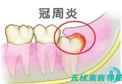 智齿发炎怎么办？挑选最佳非处方药的秘籍