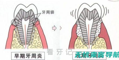 战胜牙龈