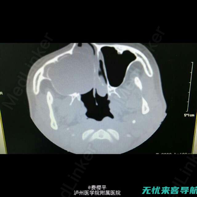 治疗上颌窦炎的中药配方