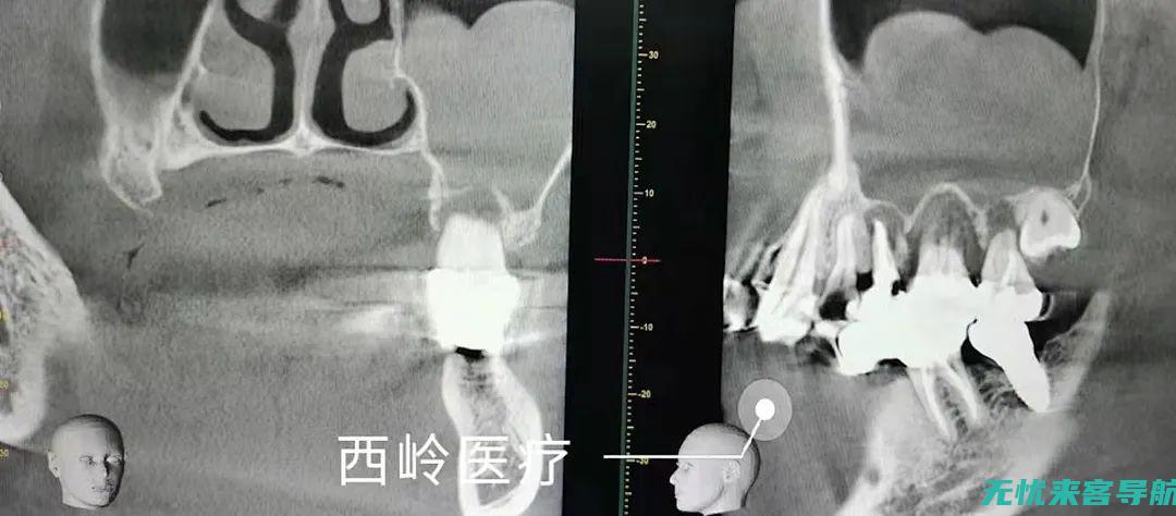 上颌窦炎与四种病症的关联