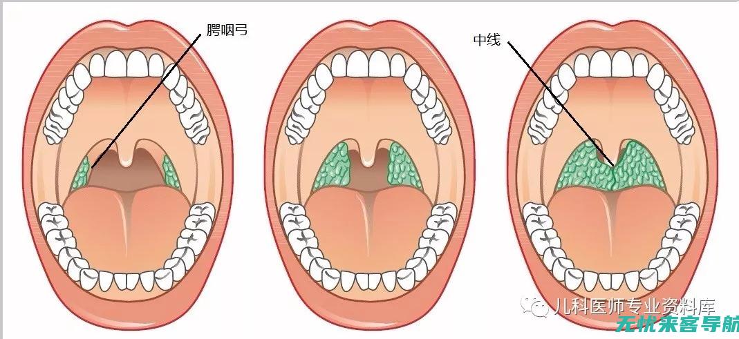 扁桃体的处方