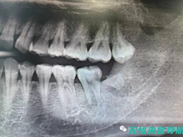 智齿引发的口腔危机