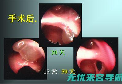 揭秘鼻腔红肿发炎的策略