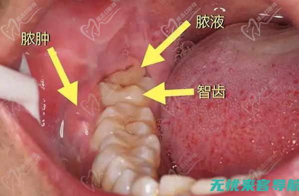 快速消炎的五大方法