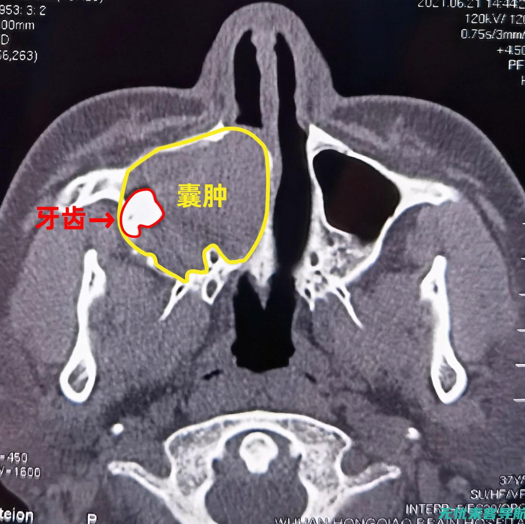 解密上颌窦肿瘤