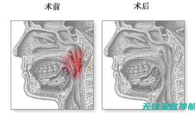 腺样体肥大早期