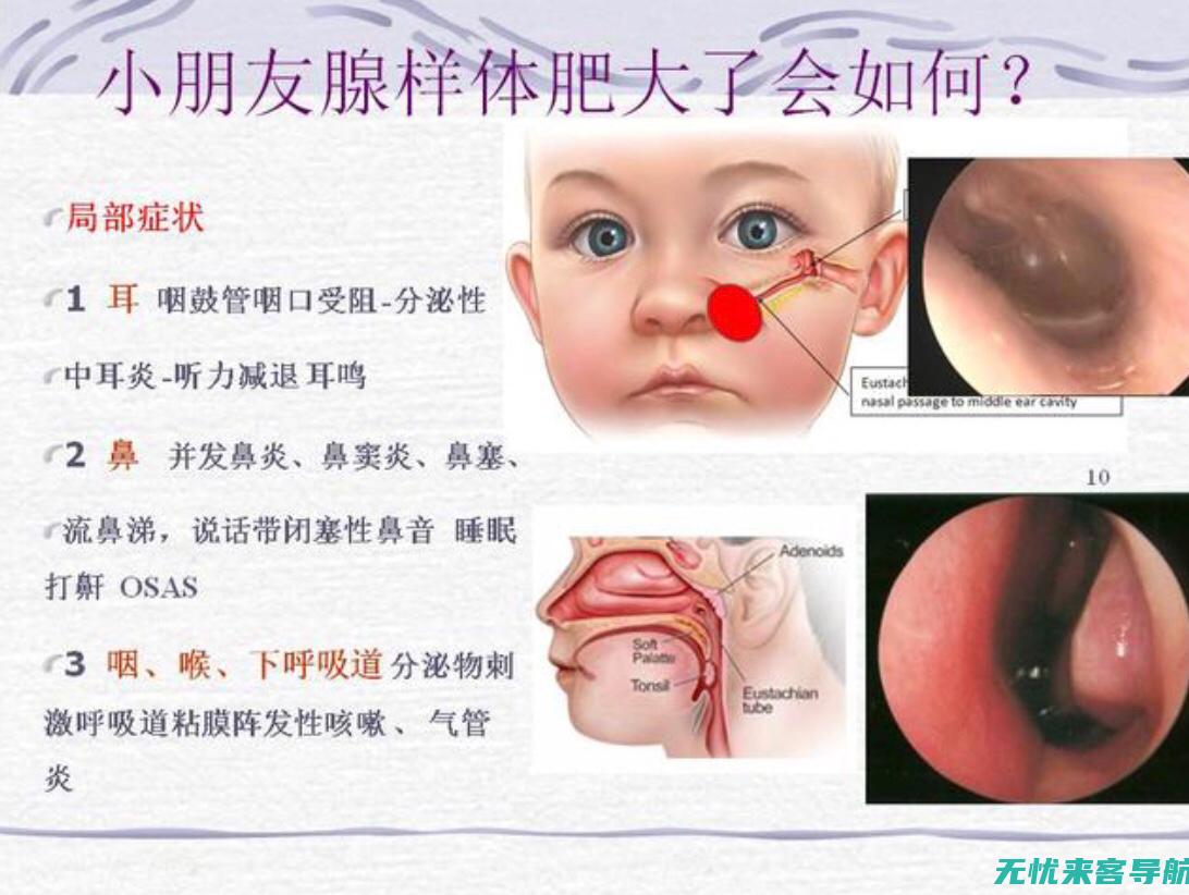 腺样体肥大患者的护理ppt