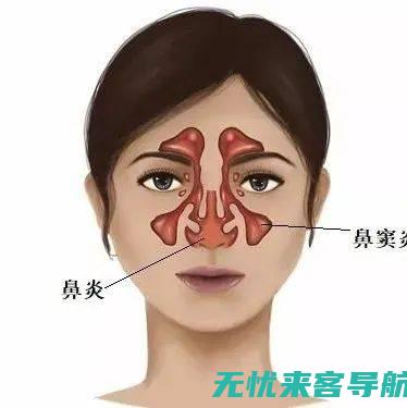 鼻窦炎症状全身酸痛