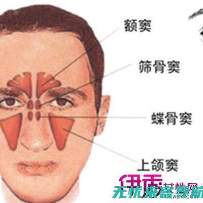 上颌窦炎揭秘它与鼻窦炎有何不同？ (上颌窦炎是啥)