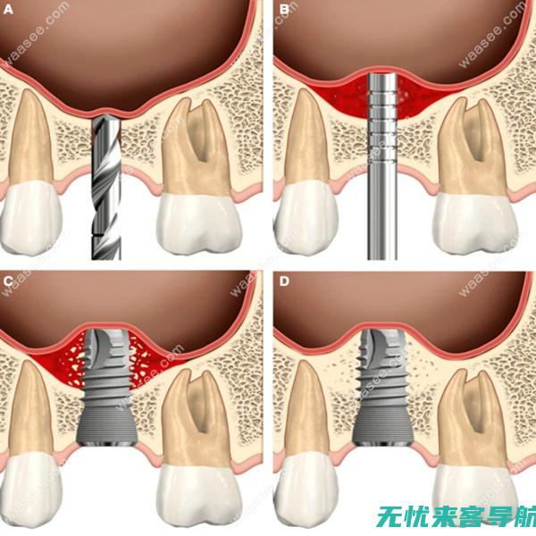 上颌窦炎：为什么有些情况下自愈是可能的？ (上颌窦炎为啥鼻子一直臭的)